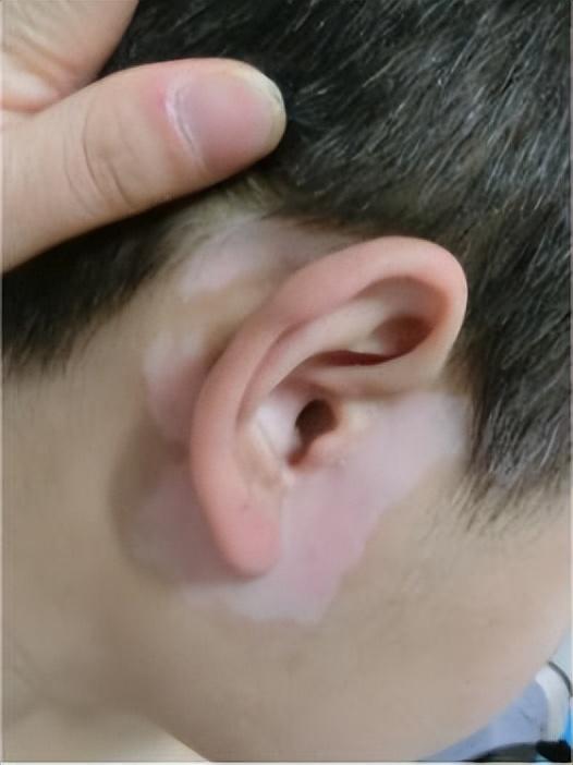 白殿瘋最新治療方法,變化帶來自信,重塑未來勵志之路