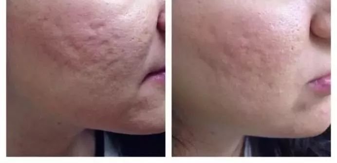 凹陷疤痕最新激光治療,重塑美麗肌膚的神奇手段!