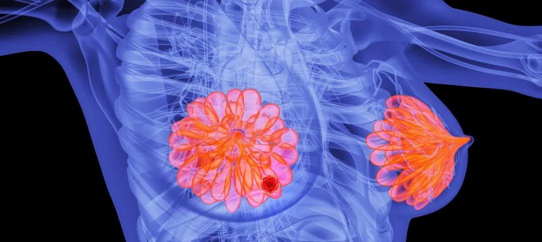 乳腺癌最新進展，溫馨日常與前沿科技并行發展之路