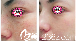 激光祛斑價(jià)格詳解與步驟指南