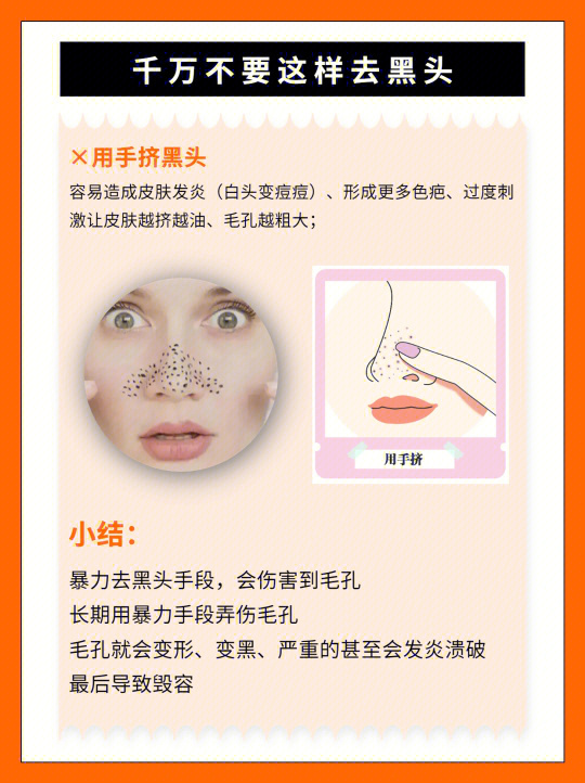 擠黑頭最新方法與注意事項詳解