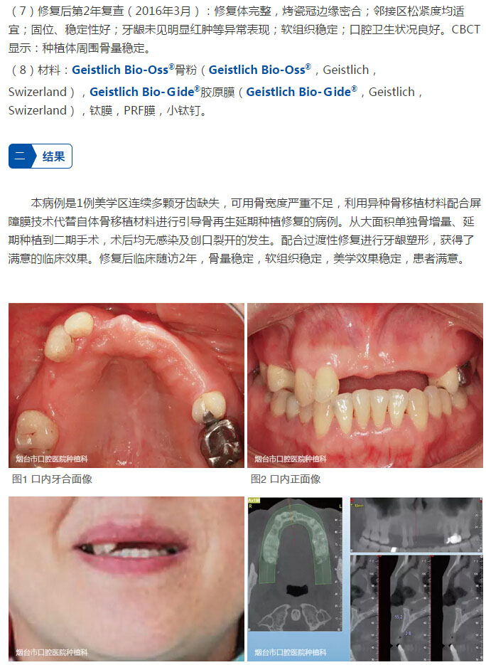 最新再生牙技術，笑迎人生，勇敢追求學習與變化的力量