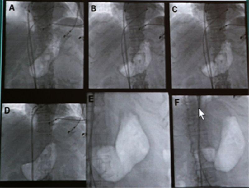 最新胃癱癥狀解析與應對方法