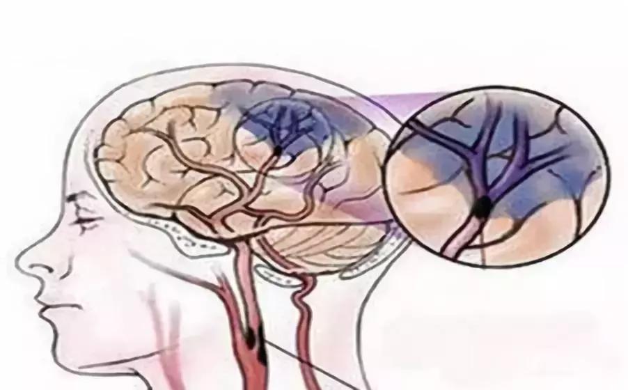 最新胃癱癥狀解析與應對方法